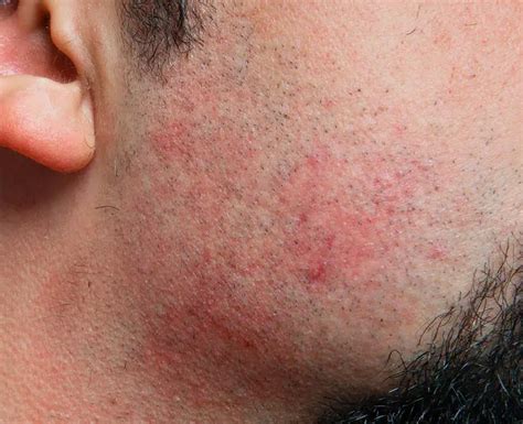 Prevention Of Razor Bumps Effective Strategies And Remedies Treat N Heal