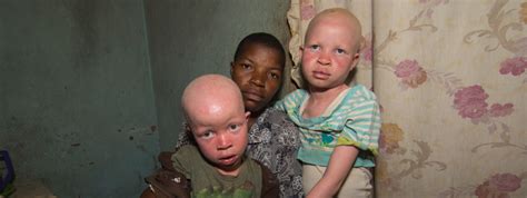 Southern Africa Persons With Albinism Especially Vulnerable In The