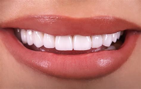 What Do You Know About Dental Veneers