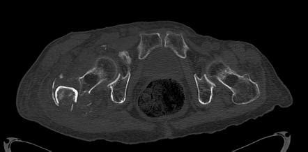 Intertrochenteric femoral fracture | Image | Radiopaedia.org
