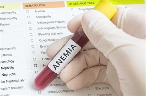 Anemia sierpowata niedokrwistość sierpowatokrwinkowa przyczyny objawy i leczenie