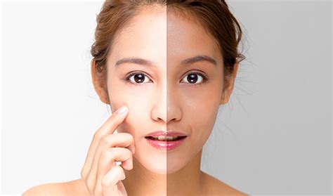 Skin Whitening Treatment Full Guide 2020