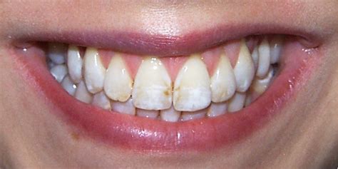 Normalerweise bleibt oben oben und unten unten. Fluoroseflecken auf den Zähnen behandeln - dentalmagazin.de