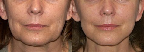 Best Product For Sagging Jowls Get More Anythinks