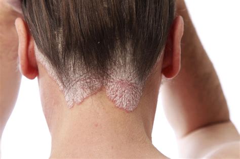 Lo Que Debes Saber Sobre La Dermatitis Seborreica Mujer