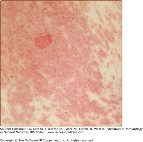 Epidermal Necrolysis Stevensjohnson Syndrome And Toxic Epidermal