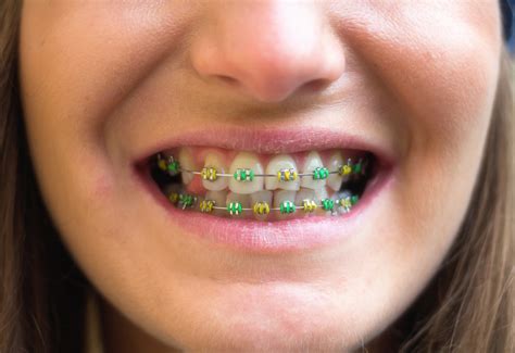 The Best Braces Color Combinations To Try Next Thomas Orthodontics