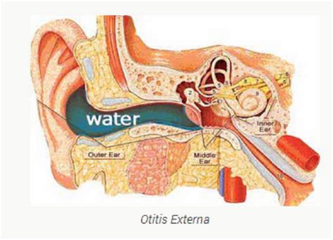 The warm, dark ear canal is the perfect place for germs to spread to, and an outer. Jodi Arias Trial Truth: The Herr Speights Sinus Theory ...