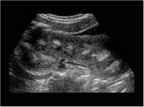 Normal Pediatric Renal Ultrasound
