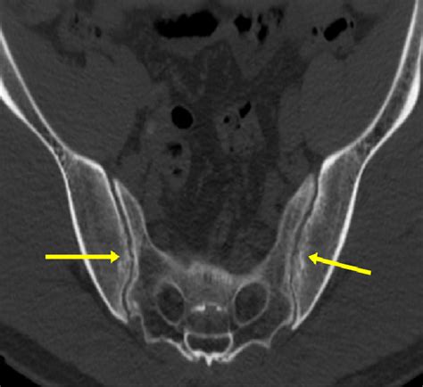 Ankylosing Spondylitis Of Si Joint Axial Scan Of Ct Of Pelvis Shows