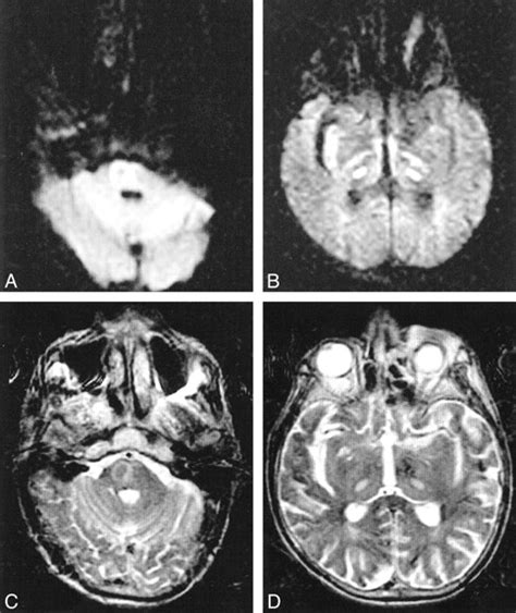 Decreased Diffusion In Central Pontine Myelinolysis American Journal
