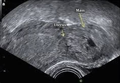 Sonographic Findings Of The Second Case Download Scientific Diagram