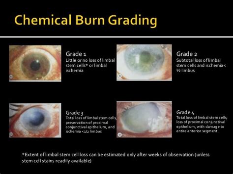 Ocular Chemical Burns Pathophysiology And Evidence Based Treatment