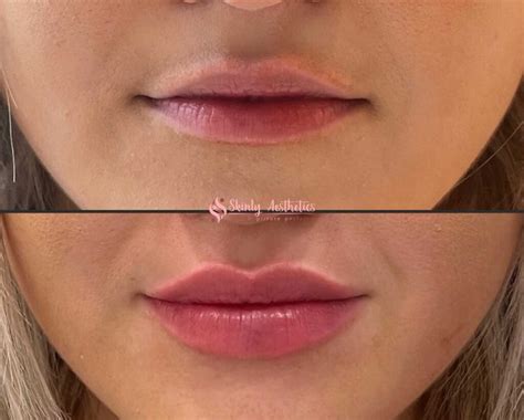 Lip Filler Injections Benefits Costs Results And Procedure Steps