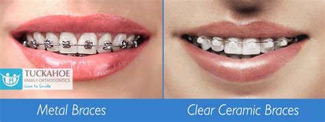 Difference Between Metal Braces And Clear Ceramic Braces