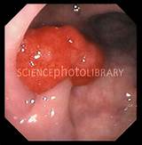 Photos of Cancerous Polyps In Colon Treatment