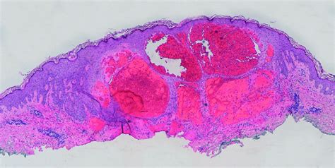 Angiokeratoma Histopathological Examination Multiple Ectatic