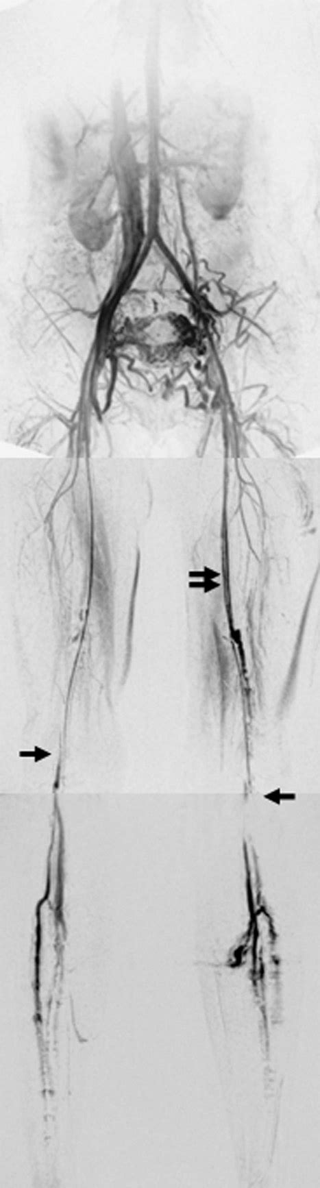 Coronal 3d Contrast Enhanced Mr Venogram Of Lower Extremities