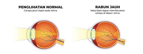 Rabun Jauh Myopia Dan Rabun Dekat Hyperopia Oasis Optometry