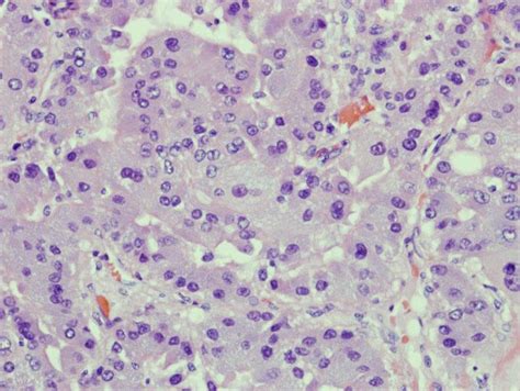 Tumor Cells Have Abundant Granular Cytoplasm Round Nuclei And