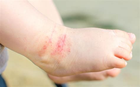 Eczema On Toddlers Feet Pre School Plan