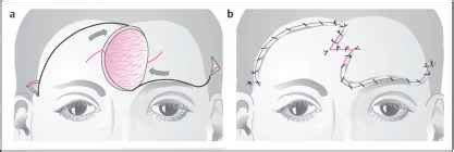 Double Rotation Flap Facial Plastic Surgery