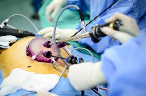 Fibroid Morcellation A Cautionary Tale Uterine Fibroid Removal