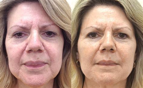 Before And After Photos Liquid Lift Imagelift™