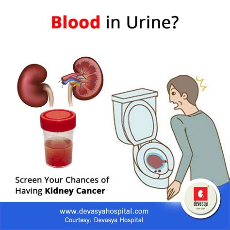 Can Passing Kidney Stones Cause Blood In Urine HealthyKidneyClub Com