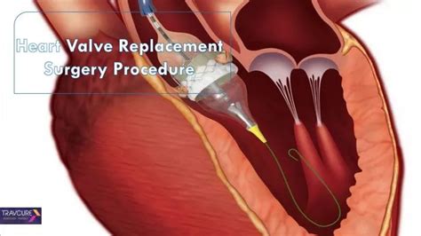 Ppt Heart Valve Replacement Surgery Procedure Powerpoint Presentation Id 7656897