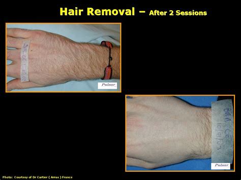 So if a clinic or spa has an ipl machine, then it's safe to assume a variety of skin conditions as well as hair removal can be addressed whereas 60 days before ipl administration. IPL Hair Removal Before & After - Estetika Studio Ltd