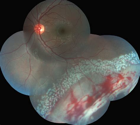 A Challenging Case Of Large Post Traumatic Retinal Tears Retina Today