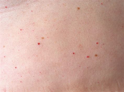 Unter petechien versteht man eine vielzahl stecknadelkopfgroßer blutungen aus den kapillaren in die haut oder schleimhäute, die auf eine störung der blutstillung hinweisen. Haemangioma senilis (angioma senilis, cherry angioma)