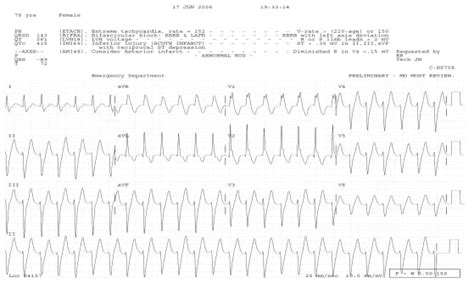 Wide Complex Tachycardias Understanding This Complex Condition Part 2