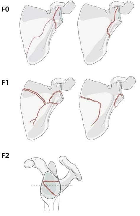 Scapula Fracture Orthobullets