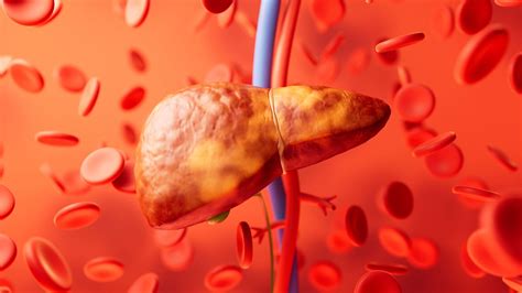 Subclasses Of Steatotic Liver Disease Can Help Determine Prognosis