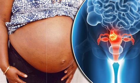 Uterine Fibroids Tablet Treatment Approved For Condition Which Can Cause Infertility Express