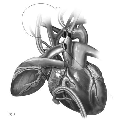 Heterotopic Heart Transplantation Technical Considerations