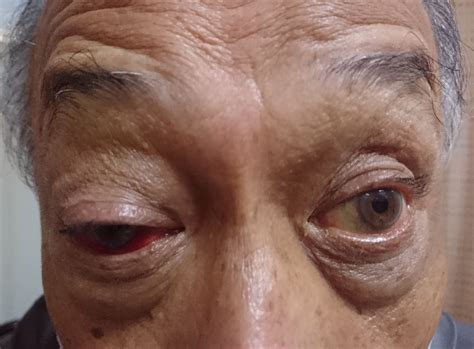 Man With Swollen Eye Emergency Medicine Journal