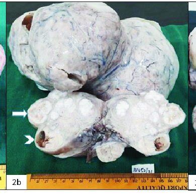 A Uterus With Adnexa And Leiomyoma Showing Bosselated Surface B