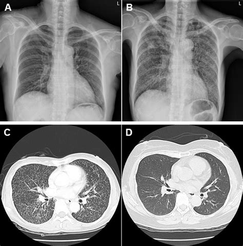 Miliary Tuberculosis In A Rheumatoid Arthritis Patient Receiving Long