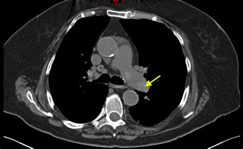 Computerised tomography scanning with contrast. Pulmonary Embolism: Diagnosis by Computerized Tomography ...