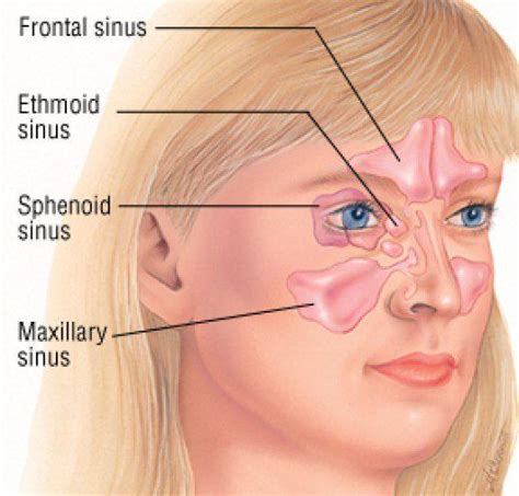 Sinusitis A Very Lowering And Painful Infection Relieve Sinus