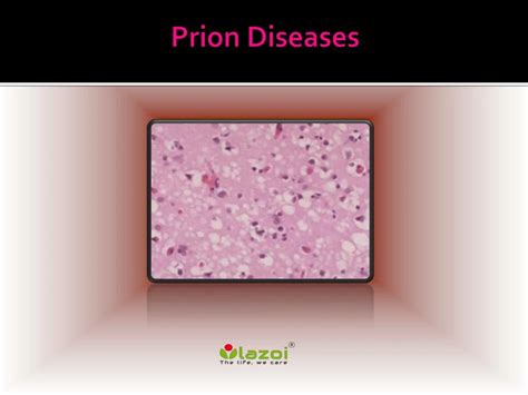 Ppt Prion Disease Causes Symptoms Daignosis Prevention And