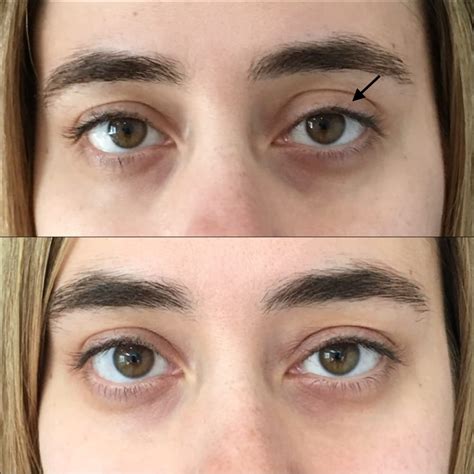 Patient 54031171 Eyelid Filler Before And After Photos Flora Levin Md