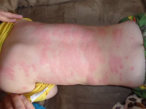 'it's hard not to feel like a vampire': Clausen in the Hausen & out in the Garden: rash two hours ...