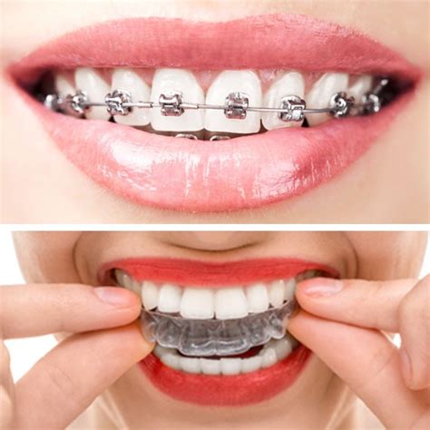 Get Free Braces In South Africa Greater Good Sa