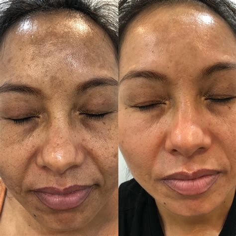 Cosmelan Depigmentation Treatment Skinnovation Laser Clinic