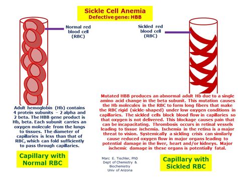 Sickle Cell Anemia Hereditary Ocular Diseases