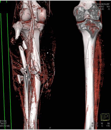 Gunshot Wound To Lower Leg With Soft Tissue And Bone
